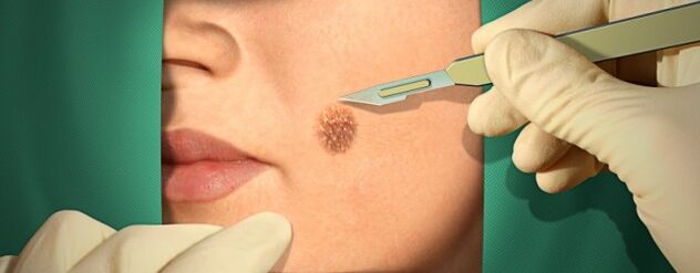 Papilloma'nın cerrahi tedavisi