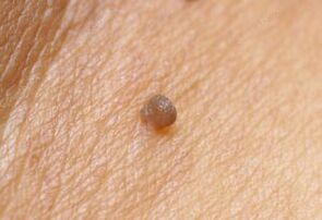 Papilloma'nın klinik resmi