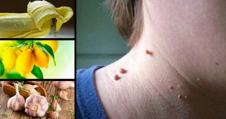Papillomlar nedir