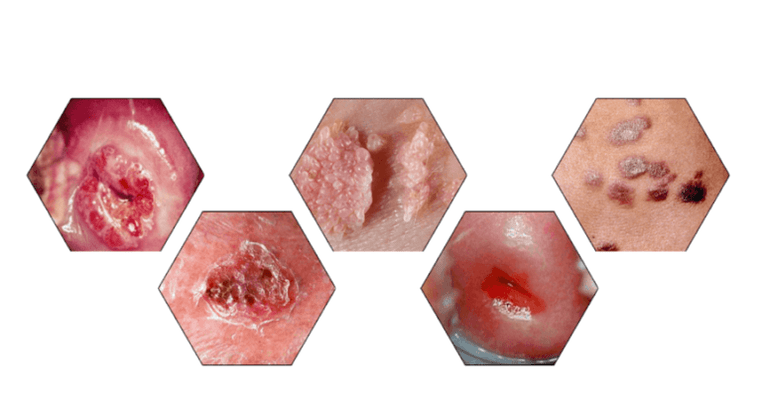 Papillomlar neden tehlikelidir