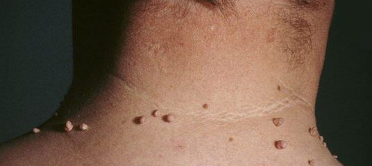 papillomlardan nasıl kurtulurum