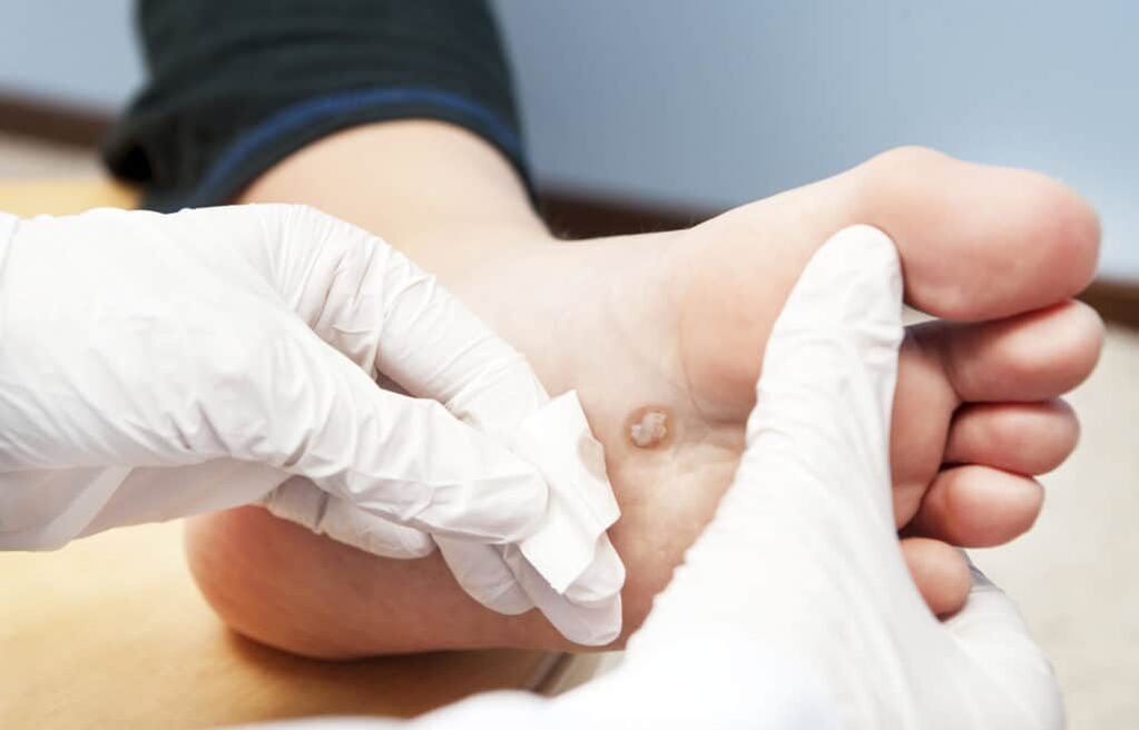 neden vücutta siğiller ortaya çıkıyor