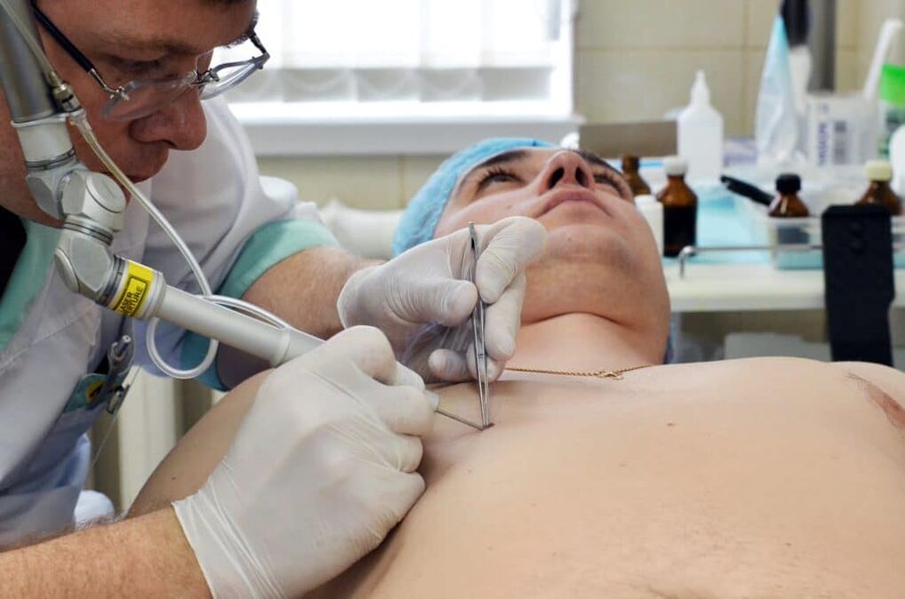 vücuttaki siğillerden nasıl kurtulurum