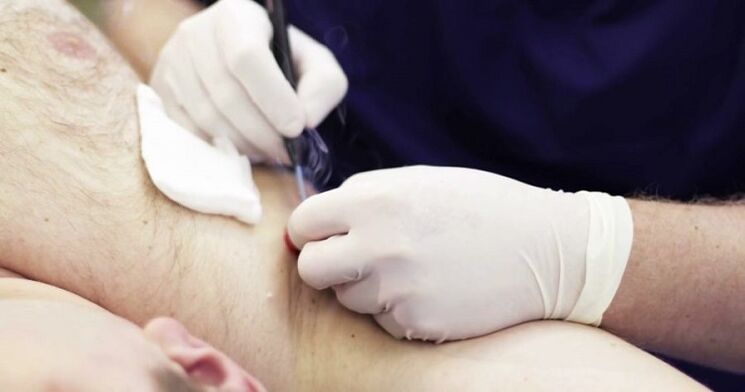 insan vücudundaki papillomları gidermek için profesyonel yöntemler