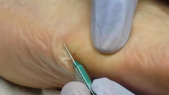 Bir plantar siğilinin cerrahi olarak çıkarılması